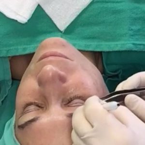 eyelid-surgery